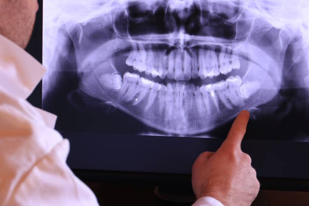 Best Knocked-Out Tooth (Avulsed Tooth) Treatment in St Vincent College, PA